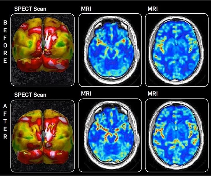 Dylan Hartley brain scans before and after treatment